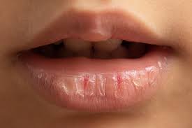 vitamin deficiency for chapped lips