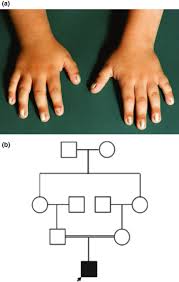 isolated recessive nail dysplasia