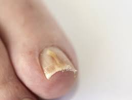 3 tips for preventing toenail fungus