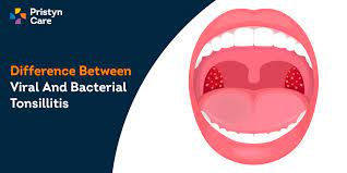 viral and bacterial tonsillitis