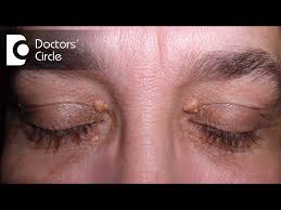 skin s from upper eyelids