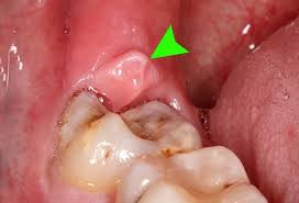 This will help to reduce the swelling, caused due to wisdom teeth growing in pain. Why We Have Wisdom Teeth Surgery Pain And Treatment