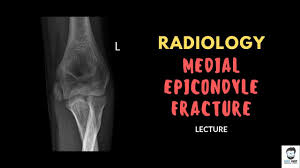 80% of avulsion fractures occur in boys with a peak age in early. Medial Epicondyle Fracture Pediatric Elbow Detailed Lecture Youtube