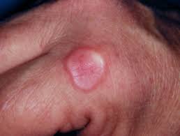 • a patient with generalized granuloma annulare experienced resolution of her lesions after six months of treatment with 1,500 mg/day of niacinamide. Granuloma Annulare Dermnet Nz