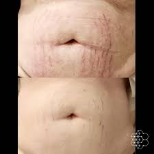 laser stretch mark removal treatment