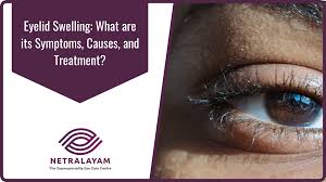 eyelid swelling what are its symptoms