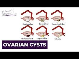 types of ovarian cysts dr micheal tahery