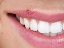 cold sores and lip fillers
