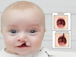 cleft lip and palate health tips in