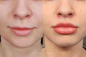 lip lift west end plastic surgery