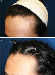 By alphamed press may 18, 2020. Stem Cell Therapy For Hair Loss Irvine Oc Hair Restoration