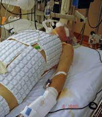 cooling pads applied to a patient after