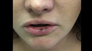 quiz dark spots on the lip clinical