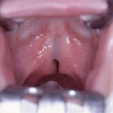 submucous cleft palate with the three