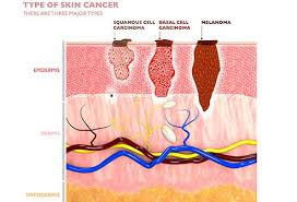 Melanomas can vary greatly in how they look. What Do The Early Signs Of Melanoma Look Like