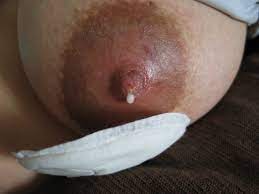 Nipple discharge 