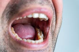 p on roof of mouth symptoms causes