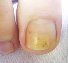 thick toenails symptoms diagnosis
