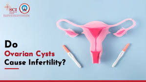 ovarian cyst and infertility in women