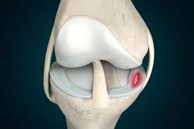 best knee meniscectomy doctors in