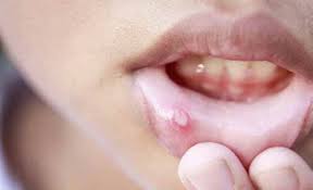 mouth ulcers recur non healing