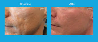 bellafill treatment for acne scarring