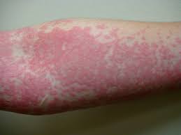 mold allergy rash
