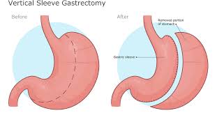 gastric sleeves what they are how
