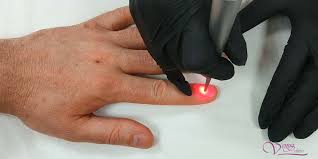 nail fungus laser treatment in kiev