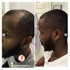 There you have it some really cool haircuts for black men from short hair, to medium length hairstyles to longer hair on top. Neograft Hair Transplants Before After Prp Therapy Before And After