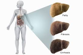 ibd and liver disease