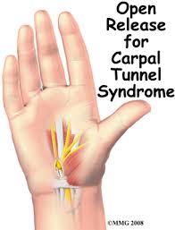 open carpal tunnel release