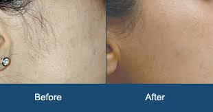 permanent laser hair removal in delhi