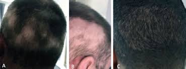 Check spelling or type a new query. Determining Safe Excision Limits In Fue Factors That Affect And A Simple Way To Maintain Aesthetic Donor Density Hair Transplant Forum International