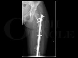open fem fracture bone defect