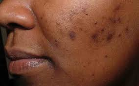 acne scars with these home remes
