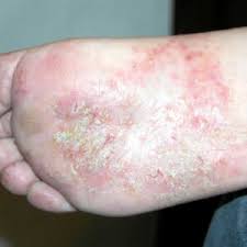 dyshidrotic eczema on the feet most