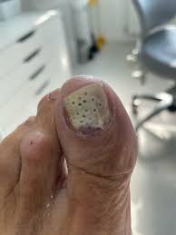 fungal nail fenestration mcr feet