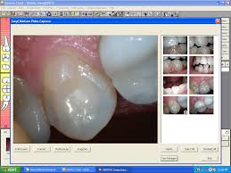 Intraoral Camera Integrates Perfectly With Dentrix Lensiora