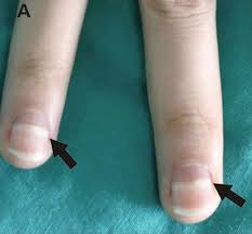 mees lines fingernails causes symptoms