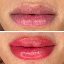 5 effective alternatives to lip fillers