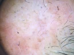 trichotillomania is the hair loss