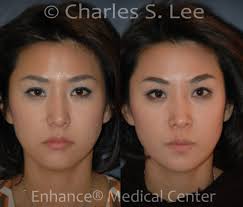 non surgical browlift midfacelift lip