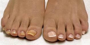 Does toenail fungus go away by. The Hydrogen Peroxide Nail Fungus Of The Feet Micinorm