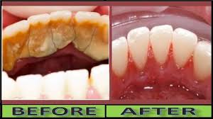 To get started, first combine both your salt and baking soda in a small container. How To Remove Tartar And Plaque In 3 Minutes Without Scaling Natural White Teeth Youtube