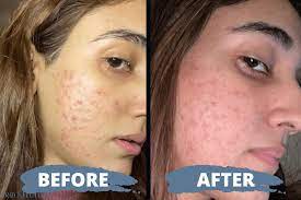 microneedling before and after pro