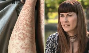 If you follow the instructions typically and consult your dermatologist before treatments, you will avoid dangerous side effects which include Primary School Teacher Suffers Horrific Burns After Laser Hair Removal Goes Horribly Wrong Daily Mail Online
