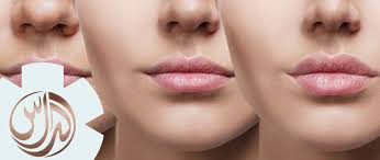 lip injection filler clinic dubai al