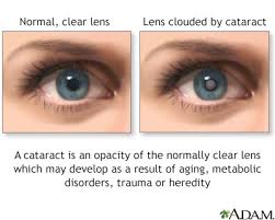 cataract removal information mount