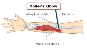 golfer s elbow explained